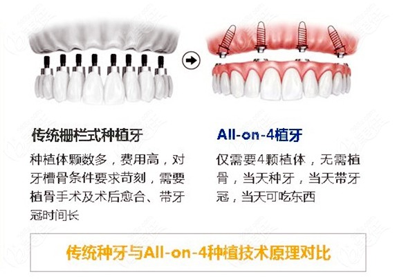 新桥口腔医院种植牙价格表