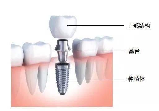 种植牙集采落地新疆！最新价格、医疗机构来啦！(图2)